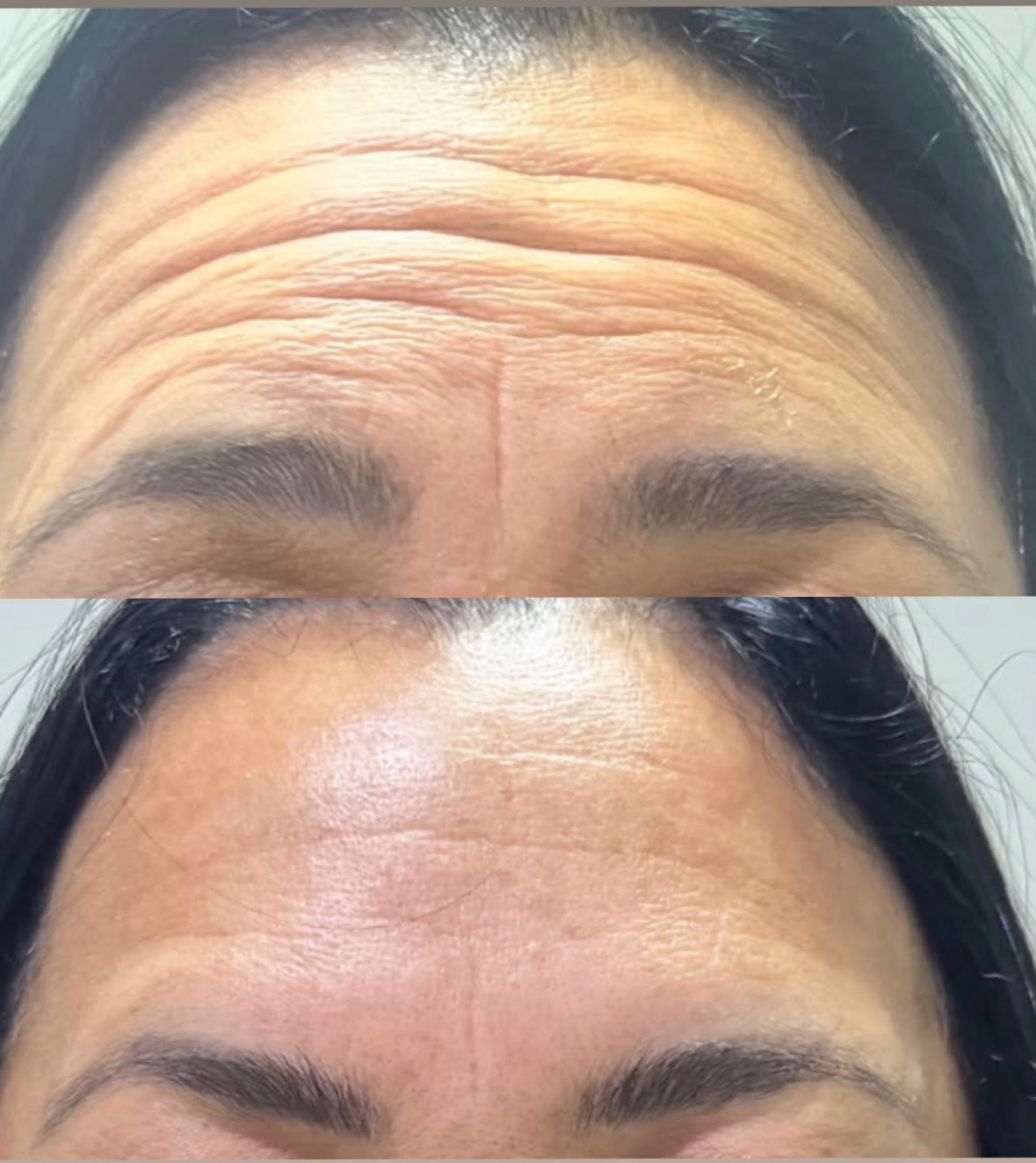 Antes e depois da aplicação de toxina botulínica