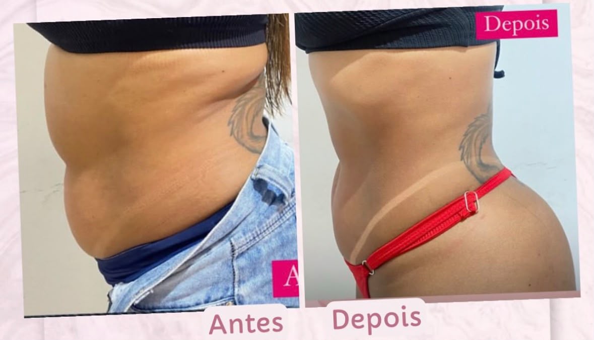 Antes e depois de protocolo de tratamento corporal