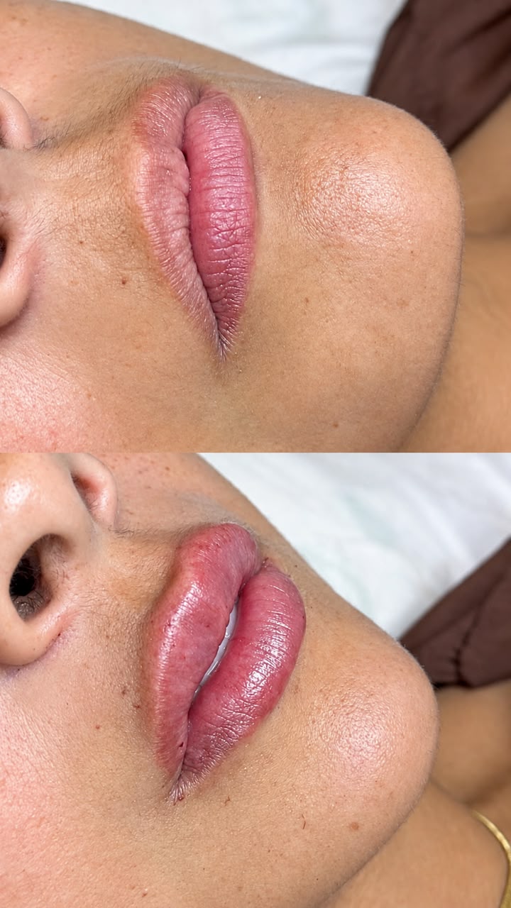 Antes e depois de preenchimento labial realizado por Maria Júlia